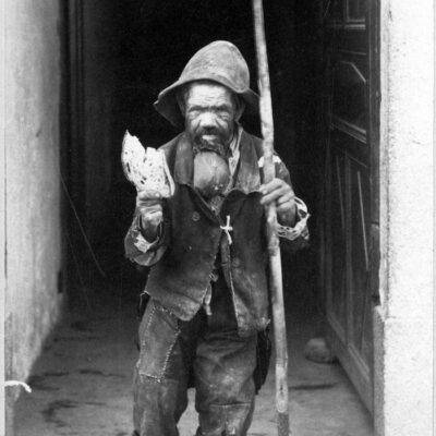 Goitreux valdotain à l’Hospice du Grand-Saint-Bernard, vers 1900 ©  Maison hospitalière du Grand-Saint-Bernard, Médiathèque Valais-Martigny