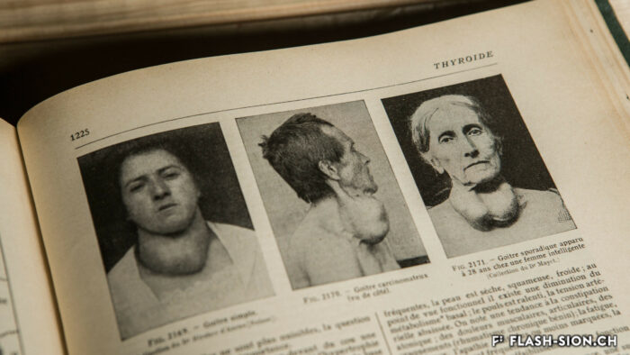 Extrait de la description des maladies de la thyroïde et du goitre dans le Larousse médical illustré, édition 1929, collection privée Maria Rohner Kamerzin © Archives de la Ville de Sion, Pentamedia